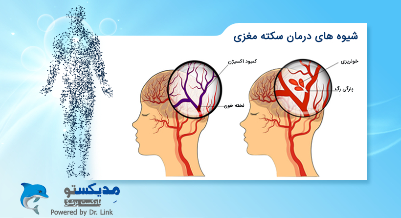   دکتر لینک | شیوه های درمان سکته مغزی 