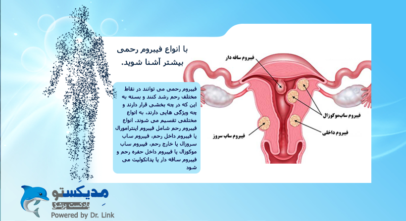   دکتر لینک | با انواع فیبروم رحمی بیشتر آشنا شوید. 