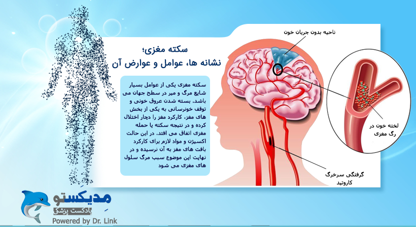 سکته مغزی؛ نشانه ها، عوامل و عوارض آن