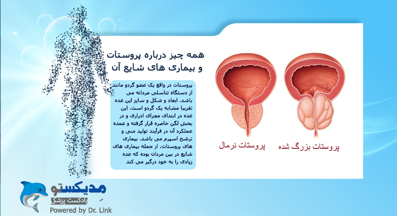 همه چیز درباره پروستات و بیماری های شایع آن