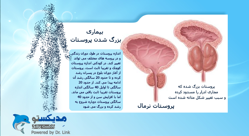   دکتر لینک | بیماری بزرگ شدن پروستات 