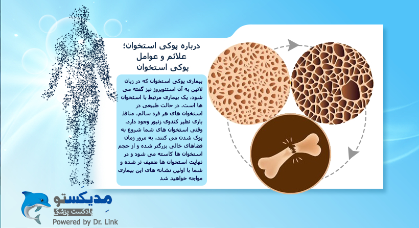 درباره پوکی استخوان؛ علائم و عوامل پوکی استخوان