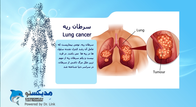   دکتر لینک | سرطان ریه 